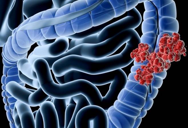 Cáncer digestivo con mayor número de casos: Cáncer de Colon