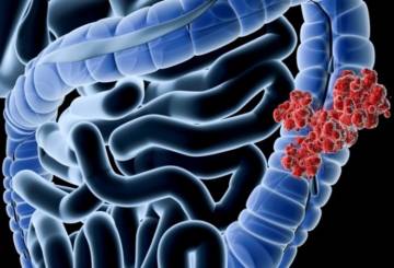 cancer de colon sintomas