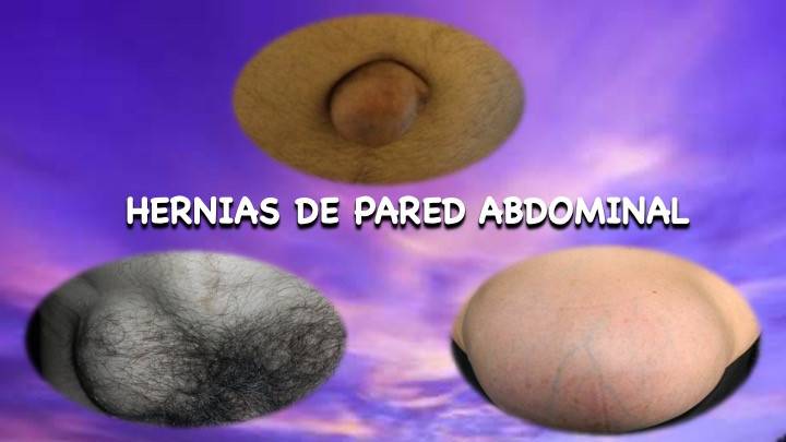 Hernias de la Pared Abdominal: Parte I