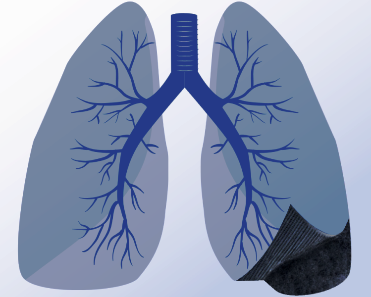 ¿En qué consiste la Fibrosis Pulmonar?