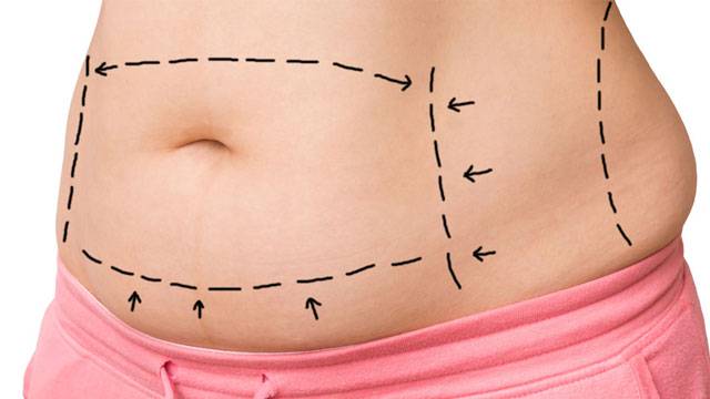 Abdominoplastía: recuperar un abdomen ideal