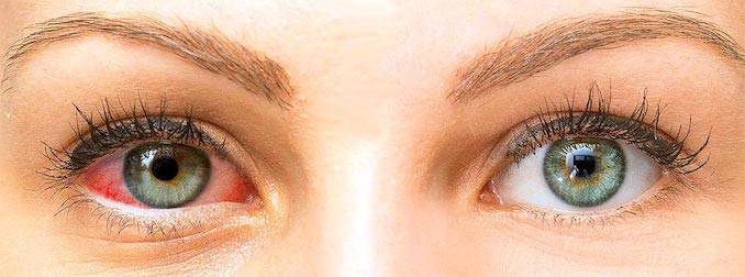 dry-eye-disease-symptoms-treatment-and-complications-top-doctors