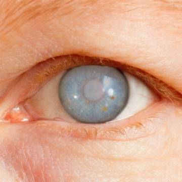glaucoma-de-angulo-abierto-y-sus-posibles-causas imágen de artículo