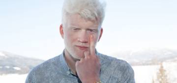 albinismo-como-se-vive-con-esta-condicion-genetica imágen de artículo