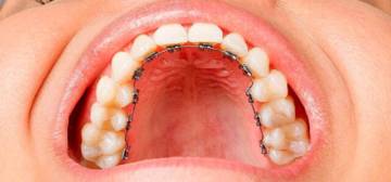 tres-tecnicas-de-ortodoncia-invisible imágen de artículo