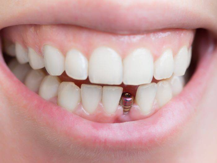 Implantes Dentales sin Dolor: ¿cómo se colocan?
