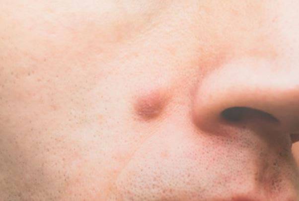 acne-que-son-los-granos-ciegos imágen de artículo