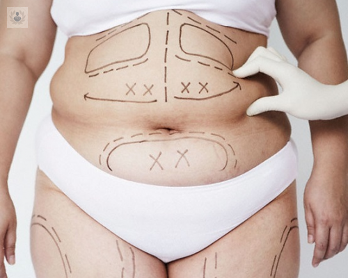 cirugia-de-la-obesidad-por-laparoscopia