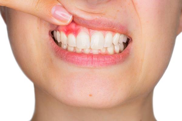 Evitar infecciones de la encía y el exceso de fuerzas sobre determinados dientes
