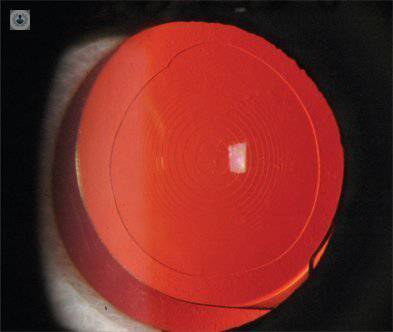 lente intraocular